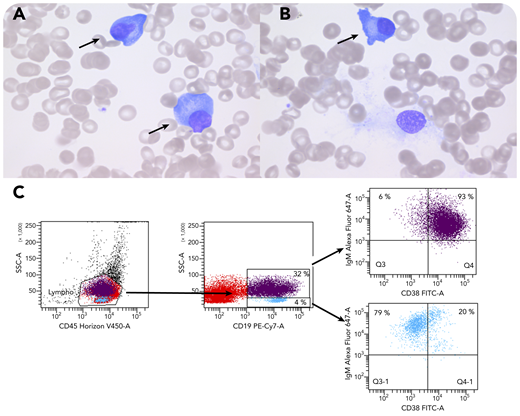 A 6-year-old boy with a history of B-cell non-Hodgkin lymphoma (Burkitt type) 2 years earlier presented with high fevers, hepatosplenomegaly, and trilineage cytopenia due to initial Epstein-Barr virus (EBV) infection. Elevated sCD25, ferritin, and triglycerides, together with hypofibrinogenemia, confirmed the diagnosis of EBV-triggered hemophagocytic lymphohistiocytosis (HLH), to which he succumbed. Bone marrow examination showed absent myelopoiesis and erythropoiesis with predominant T cells, hemophagocytosis, and immunohistochemically ∼25% CD38+CD20− EBV+ plasma cells. T and natural killer (NK) cells showed no SAP protein expression by flow cytometry, confirming the diagnosis of X-linked lymphoproliferative disease (XLP), genetically confirmed by a hemizygous variant (c.163C>T;p.Arg55*) in SH2D1A. This primary immunodeficiency is characterized by disturbed T:B-cell interaction, leading to impaired killing of EBV-infected B cells. It typically presents as EBV-triggered HLH, B-cell lymphoma, or hypogammaglobulinemia. The bone marrow smear (panels A-B; ×100 objective, original magnification ×1000; Wright-Giemsa stain) shows scattered plasmacytoid cells (panels A-B, arrows) in an otherwise aplastic bone marrow with hemophagocytosis as a typical finding in XLP with acute EBV infection. These cells represent EBV-infected CD19+CD38+IgM+ plasma blasts (panel C, purple), which are insufficiently killed by the SAP-deficient T and NK cells.