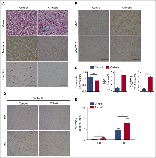Hepatic Trf, iron, MDA, and SLC39A14 levels in liver biopsy samples obtained from patients with liver cirrhosis and in Trf-LKO mice. Liver biopsy samples were obtained from 20 patients with liver cirrhosis and 20 control subjects who underwent resection for hepatocellular carcinoma. (A,B) Representative images of liver sections stained with Masson’s trichrome, Trf IHC, Perls Prussian blue, MDA IHC, and SLC39A14 IHC. (C) Quantitative analyses of Trf, MDA, and SLC39A14 staining of liver sections obtained from control and cirrhotic biopsy samples. (D) Representative images of murine liver sections stained with Slc39a14 obtained from 12-week-old SID-fed and HID-fed control mice and Trf-LKO mice. The scale bars represent 100 μm. (E) Quantitative analyses of hepatic Slc39a14 staining from 12-week-old SID-fed and HID-fed control mice and Trf-LKO mice. *P < .05, **P < .01, Student t test.