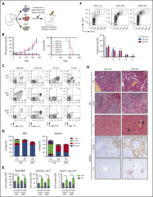 In vivo modeling of erythroid transformation by aberrant SKI expression. (A) Experimental design: hematopoietic stem cells (HSC), granulocyte-monocyte progenitors (GMP), and megakaryocyte-erythroid progenitors (MEP) were sorted from WT mice, retrovirally transduced with SKI or an empty vector (Ctrl) carrying an IRES-GFP expression cassette, and injected into lethally irradiated recipients. (B) Left, GFP+ cells (percentage) in the BM of transplanted mice. Mean plus or minus SD is shown (n = 5 per group). Right, Kaplan-Meier plot of disease symptoms in transplanted mice. Only mice transplanted with SKI-transduced HSCs and MEP developed disease. (C) Flow cytometry analysis of myeloid cells (CD11b+Gr-1+), erythroid progenitors (CD71+Ter119+), B cells (B220+), and T cells (CD4+CD8+) gated for viable GFP+ cells, in spleens of mice transplanted with HSC (Ctrl vs SKI) or MEP (SKI) cells. (D) Percentage of myeloid cells (CD11b+Gr1+), erythroid progenitors (CD71+Ter119+), B cells (B220+), and T cells (CD4+CD8+) within viable GFP+ cells, in HSC-Control (Ctrl), HSC-SKI, and MEP-SKI in primary mice BM and spleen. Mean plus or minus SD is shown (n = 5 per group). (E) Number of GFP+ and GFP− total BM cells, myeloid cells (CD11b+Gr1+), and erythroid progenitors (CD71+Ter119+) in the BM of diseased primary recipients. Mean plus or minus SD is shown (n = 5 per group). (F) Flow cytometry analysis of terminal erythroid differentiation in the BM of diseased HSC (Ctrl and SKI) and MEP-SKI recipients, determined by forward scatter (FSC-A) and CD44 expression gated for viable Ter119+ cells. Bottom panel, Mean plus or minus SD (n = 5 per group) of the percentage of each population. (G) Histopathology analysis of BM spleen and liver of mice transplanted with HSC-Ctrl (left row) or HSC-SKI (right row) stained with hematoxylin-eosin (top 6 photomicrographs; original magnification ×20) or with a GATA1 antibody (bottom 4 photomicrographs; original magnification ×20).