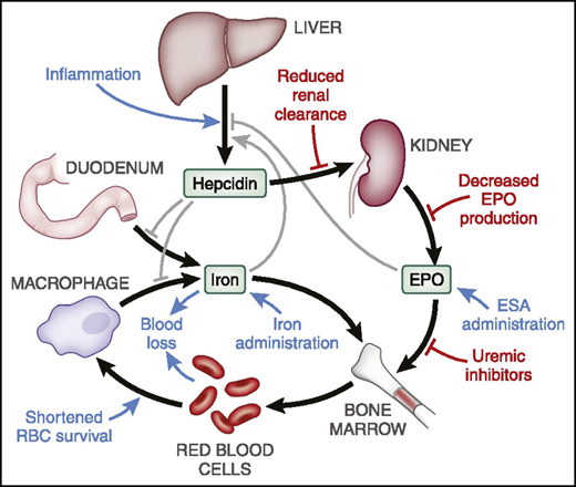 Hepcidin plays a central role in iron metabolism and availability for erythropoiesis. When levels are elevated, intestinal iron absorption is diminished and release of stored reticuloendothelial system iron is blocked. The net effect is reduced iron availability for erythropoiesis. RBC, red blood cell. Republished with permission of the American Society of Nephrology from Babitt et al2; permission conveyed through Copyright Clearance Center, Inc.