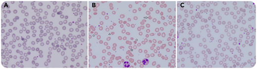 An 80-year-old man was hospitalized with severe acute respiratory syndrome coronavirus 2 (SARS-CoV-2) pneumonia. Because of worsening clinical and radiological lung involvement, the protease inhibitors lopinavir/ritonavir were prescribed. Eight days later, schistocytes appeared on the patient’s blood smear (panel B). His laboratory results indicated the following: hemoglobin, 7 g/dL; reticulocytes, 19 × 103/µL; platelets, 462 × 103/µL; and leukocytes, 12.3 × 103/µL. Lactate dehydrogenase was elevated (607 U/L) but all other hemolysis parameters and creatinine were normal. Blood smear testing (panels A-C: original magnification ×1000, hematoxylin and eosin stain) showed marked anisopoikilocytosis (panel B) with echinocytes (☆), bite cells (△), keratocytes (⇨), and ghost cells (○). These changes were not present the day before lopinavir/ritonavir administration (panel A) and disappeared 5 days after treatment cessation (panel C).