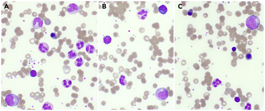 A 7-year-old girl with severe acute respiratory syndrome coronavirus 2 (SARS-CoV-2) exposure presented with 4 days of fever, nausea, vomiting, diarrhea, and dark urine. At presentation, she was febrile (39.7°C), tachycardic, and tachypneic with normal blood pressure. Conjunctivitis, oropharyngeal erythema, cracked lips, and a distended abdomen were noted. Polymerase chain reaction testing for SARS-CoV-2 was positive. Laboratory testing showed elevated inflammatory markers, liver enzymes, and D-dimer. Two days after admission, her complete blood count revealed the following: white blood cell count, 63.1 × 109/L; hemoglobin, 6.9 g/dL (with a normal mean corpuscular volume); and platelets, 370 × 109/L. A peripheral blood smear showed 55% neutrophils, 9% bands, 8% metamyelocytes, 5% myelocytes, 13% monocytes, and 10% lymphocytes (panel A; original magnification ×600, Wright-Giemsa stain). There were also plasmacytoid lymphocytes (panel B; original magnification ×600, Wright-Giemsa stain), anisocytosis, and 7% nucleated red blood cells (panel C; original magnification ×600, Wright-Giemsa stain). The patient received 1 mg/kg prednisone and 81 mg of aspirin daily and changes resolved in 4 days.