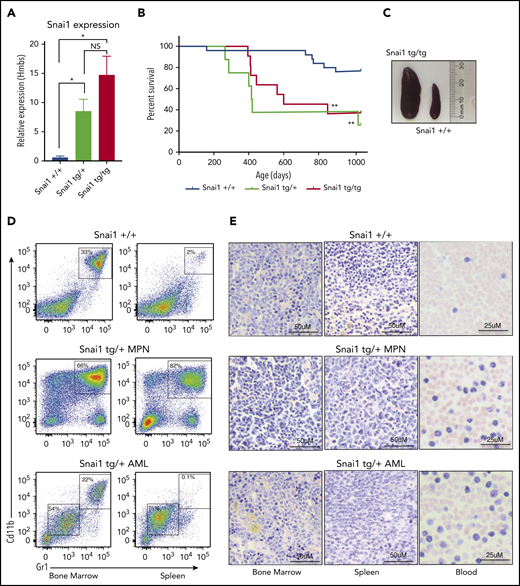 Enforced hematopoietic expression of Snai1 predisposes mice to AML development. (A) Quantitative real-time PCR analysis showing Snai1 mRNA levels were approximately eightfold to 15-fold higher in transgenic mouse bone marrow, as compared with WT controls (Snai1+/+, n = 3; Snai1tg/+, n = 3; Snai1tg/tg, n = 3). Data are presented as mean + standard error of the mean. (B) Kaplan-Meier plot showing Snai1 transgenic mice become moribund from ∼12 months of age, with a median age of 601 days for Snai1tg/tg and 418 days for Snai1tg/+. No significant difference in survival was observed between heterozygous and homozygous transgenic mice. (C) Pictograph showing splenomegaly in an Snai1tg/tg mouse. (D) Representative flow cytometric plots with predominant CD11b+GR1+ cell populations in both the bone marrow and spleen. Flow cytometric profiles of CD11b and GR1 expression on bone marrow and spleen cells are shown for a representative WT mouse in the top panel, a moribund mouse with a myeloproliferative disease in the middle panel, and a mouse with AML in the bottom panel. (E) Hematoxylin and eosin staining of bone marrow, spleen, and peripheral blood histological sections of the same mice as in panel D are shown. A representative WT mouse is depicted in the top panel. A representative mouse with myeloproliferative disease is shown in the middle panel, with evidence of granulocytic cell infiltration in the spleen and blood, increased numbers of granulocytic precursor and mature cells in the bone marrow and spleen, and reduced erythropoiesis. In the bottom panel, a representative mouse with AML is shown as evidenced by myeloid blast cell infiltration into bone marrow, spleen, and peripheral blood, along with loss of normal hematopoiesis in the bone marrow and spleen. *P < .05 1-tailed Student unpaired t test, **P < .01 Mantel-Cox test.