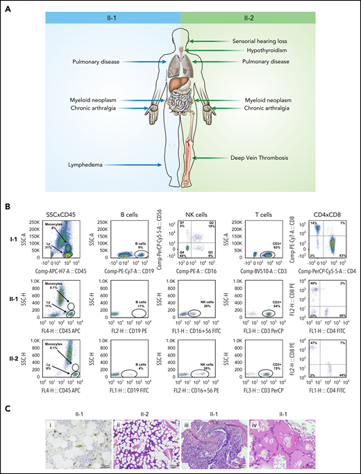 Clinical, laboratory, and pathologic features of patients with GATA2 deficiency. (A) Clinical findings in patients II-1 and II-2. (B) Immunophenotyping of the father (I-1), and brothers (II-1 and II-2) demonstrate normal peripheral blood counts in I-1 and monocytopenia and B-cell depletion in II-1 and II-2. (C) Bone marrow biopsy showing CD34+ clusters by immunohistochemistry in II-1 (i) and trilineage hypoplasia in II-2 (ii) and lung biopsy demonstrating chronic lymphoplasmacytic infiltrate (iii) and alveolar proteinosis (iv) in II-1. Hematoxylin and eosin stain. Ly, lymphocytes.