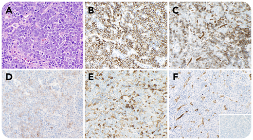 A 32-year-old man with anemia (hemoglobin, 9.9 g/dL) and thrombocytopenia (platelets, 76 × 109/L) had a bone marrow biopsy showing a myeloid neoplasm with PCM1-JAK2 fusion with left-shifted hyperplasia without increase in blasts, mild megakaryocytic atypia, and marked reticulin fibrosis. A computed tomography scan showed extensive lymphadenopathy and splenomegaly. An axillary lymph node biopsy was performed showing partial effacement by a diffuse infiltrate of large atypical cells with moderate basophilic cytoplasm, round nuclear contours, vesicular chromatin, prominent nucleoli, and evidence of sinusoidal involvement (panel A; hematoxylin and eosin stain, 40× objective, original magnification ×400). These cells were notably positive for E-cadherin (panel B; 20× objective, original magnification ×200), glycophorin A (subset, panel C; 20× objective, original magnification ×200), CD117 (subset, panel D; 20× objective, original magnification ×200), and EMA, and negative for CD45 (panel E; 20× objective, original magnification ×200), CD34 (panel F; 20× objective, original magnification ×200), MPO (panel F inset; 20× objective, original magnification ×200), CD3, CD20, CD30, and TdT, supporting a diagnosis of myeloid sarcoma with erythroblastic differentiation. The diagnosis was subsequently confirmed by fluorescence in situ hybridization testing, which was positive for evidence of a rearrangement involving JAK2.