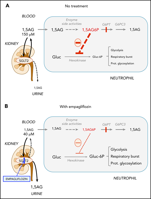Empagliflozin lowers 1,5AG plasma levels and restores neutrophil function in GSD-Ib patients by lowering neutrophil 1,5AG6P. 1,5AG is a nondegradable glucose analog present in blood (∼150 µM). It is slowly phosphorylated to 1,5AG6P by the side activities of hexokinases and adenosine 5′-diphosphate–dependent glucokinase present in neutrophils. To prevent its accumulation, 1,5AG6P is transported into the endoplasmic reticulum by G6PT and dephosphorylated by the phosphatase G6PC3. (A) In GSD-Ib patients who are deficient in G6PT, 1,5AG6P accumulates in neutrophils. It is the rise in the concentration of 1,5AG6P that intoxicates neutrophils by strongly inhibiting hexokinases and depleting the intracellular pool of G6P (Gluc-6P) that is vital for neutrophils to survive and function.14 (B) Inhibiting the renal SGLT2 with empagliflozin leads to glucosuria by preventing the renal reabsorption of glucose, but also of 1,5AG, which results in its urinary excretion. Consequently, this leads to an approximate fourfold reduction in the concentration of 1,5AG in blood and of 1,5AG6P in neutrophils. This relieves the inhibition of hexokinases and increases the pool of G6P and of the metabolites in downstream pathways, improving glycolysis, respiratory burst, and protein glycosylation. Neutrophils function better, and neutropenia is partly corrected.