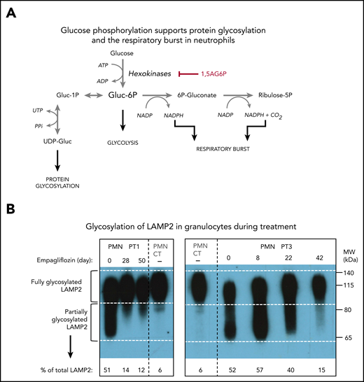 Empagliflozin corrects protein glycosylation and oxidative burst in GSD-Ib patients after empagliflozin treatment. (A) Role for G6P (Gluc-6P) in uridine diphosphate glucose (UDP-Gluc) production (essential for protein glycosylation) and reduced NAD phosphate (NADPH) production (essential for the respiratory burst reactions). (B) Western blots illustrating the almost complete correction of glycosylation for the protein LAMP2 in granulocytes (PMNs) from PT1 and PT3 isolated before and during empagliflozin treatment and compared with a healthy control (CT). (C) Empagliflozin treatment corrected the defective respiratory burst in PT4. Whole blood was stimulated with phorbol myristate acetate (PMA) at 37°C for 15 minutes. Red blood cells were lysed, and the sample was analyzed immediately by flow cytometry with gating set on neutrophils. Gate B: neutrophils showing increased DHR123 fluorescence compared with background fluorescence in unstimulated cells. Gate C: PT4 PMA-stimulated neutrophils showing DHR123 fluorescence equivalent to that of the date-matched normal control. ADP, adenosine 5′-diphosphate; ATP, adenosine triphosphate; MW, molecular weight; PPi, inorganic pyrophosphate; UTP, G1P uridylyltransferase.