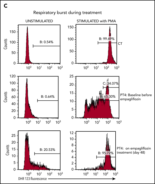 Empagliflozin corrects protein glycosylation and oxidative burst in GSD-Ib patients after empagliflozin treatment. (A) Role for G6P (Gluc-6P) in uridine diphosphate glucose (UDP-Gluc) production (essential for protein glycosylation) and reduced NAD phosphate (NADPH) production (essential for the respiratory burst reactions). (B) Western blots illustrating the almost complete correction of glycosylation for the protein LAMP2 in granulocytes (PMNs) from PT1 and PT3 isolated before and during empagliflozin treatment and compared with a healthy control (CT). (C) Empagliflozin treatment corrected the defective respiratory burst in PT4. Whole blood was stimulated with phorbol myristate acetate (PMA) at 37°C for 15 minutes. Red blood cells were lysed, and the sample was analyzed immediately by flow cytometry with gating set on neutrophils. Gate B: neutrophils showing increased DHR123 fluorescence compared with background fluorescence in unstimulated cells. Gate C: PT4 PMA-stimulated neutrophils showing DHR123 fluorescence equivalent to that of the date-matched normal control. ADP, adenosine 5′-diphosphate; ATP, adenosine triphosphate; MW, molecular weight; PPi, inorganic pyrophosphate; UTP, G1P uridylyltransferase.