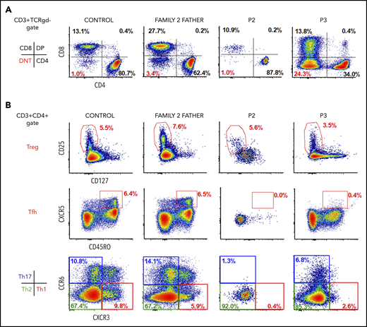 Immunophenotyping of patients and heterozygous relatives. (A) Representative flow cytometry dots plots showing increased levels of DNTs in P3 and normal levels in healthy control, heterozygous relative, and P2. (B) Representative flow cytometry dot plots showing normal levels of Tregs (CD3+CD4+CD25+CD127low) in patients and heterozygous relative, lack of Tfh cells (CD3+CD4+CXCR5+CD45RO+), reduced Th1 cells (CD3+CD4+CCR6−CXCR3+) and Th17 cells (CD3+CD4+CCR6+CXCR3−), and differentiation preference toward Th2 cells (CD3+CD4+CCR6−CXCR3−) in P2 and P3.