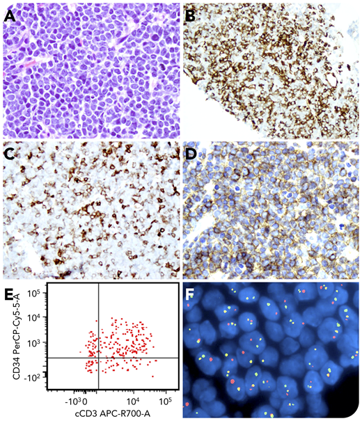 A 43-year-old man was diagnosed with Ph+ chronic myeloid leukemia (CML) in 2017 and was prescribed tyrosine kinase inhibitor therapy with suboptimal compliance. In January 2020, he had 22% aberrant myeloid blasts in his peripheral blood (only 3% to 5% blasts in bone marrow). Therapy with dasatinib was initiated, but he was lost to follow-up. A few weeks later, he presented with abdominal pain, and a 4 × 3.6-cm retroperitoneal soft tissue mass was found on a computed tomographic scan. Hematoxylin and eosin staining of the mass showed sheets of atypical, medium-sized blasts with a high nucleus/cytoplasm ratio (panel A; original magnification ×400). These blasts were partially positive for CD34 (panel B; original magnification ×200); dimly and partially positive for CD117 (panel C; original magnification ×200), CD3 (not shown), CD33 (panel D; original magnification ×400), and GATA3 (not shown); but negative for myelomonocytic, B- and T-cell antigens, including CD1a, CD2, CD4, CD5, CD7, CD8, and TdT. Limited flow cytometry showed that the blasts were positive for cytoplasmic CD3 (panel E). Fluorescence in situ hybridization showed that 91% of the blasts harbored the BCR-ABL1 fusion (panel F, yellow signals; original magnification ×1000). There was no monoclonal TCR-γ gene rearrangement.