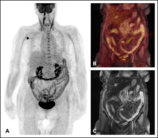 FDG-PET-MRI of a 70-year-old patient with acute intestinal GVHD. (A) Maximum intensity projection of PET and (C) the fused PET-MRI show increased FDG uptake in small and large bowel. (B) Coronary T1-weighted postcontrast MRI allows for assessment of corresponding morphological changes, including mural hyperenhancement, wall thickening, mural stratification, and the Comb sign.