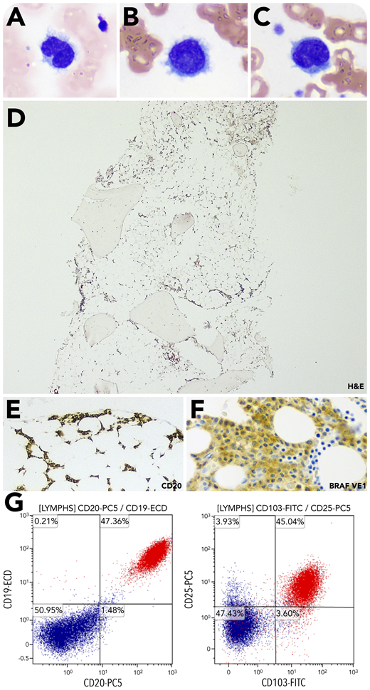 A 56-year-old man underwent a bone marrow (BM) biopsy for leukopenia of several years. Hemogram revealed a low white blood cell count of 1.8 × 109/L (reference, 4.5-11 × 109/L; differential: 47% neutrophils, 46% lymphocytes, 4% monocytes) and thrombocytopenia (platelets = 100 × 109/L; reference, 150-450 × 109/L). Hemoglobin was within normal limits. The BM aspirate smear disclosed marrow particles with atypical lymphocytes characterized by reniform nuclei, reticular chromatin, absent nucleoli, and circumferential cytoplasmic projections (panels A-C, original magnification ×1000, Wright-Giemsa stain). The core biopsy revealed a markedly hypocellular marrow, with ∼10% cellularity (panel D, original magnification ×40, hematoxylin and eosin stain), which was composed predominantly of small lymphocytes positive for CD20 and BRAFVE1 (a mouse monoclonal antibody against BRAF V600E mutant) (panels E-F, original magnification ×500, CD20 and BRAFVE1). Flow cytometry identified λ-restricted B cells expressing CD20 (bright), CD22 (bright), CD103, and CD25 (panel G). Molecular testing confirmed BRAFV600E mutation. Radiographic studies did not show splenomegaly or lymphadenopathy.