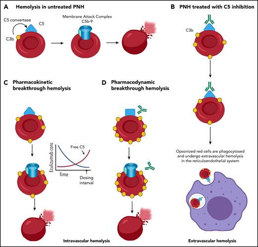 Mechanisms of hemolysis in PNH. (A) Loss of CD55 and CD59 on PNH red cells leaves them vulnerable to complement-mediated intravascular hemolysis. (B) PNH red cells from patients with PNH treated with C5 inhibition (eculizumab or ravulizumab) often become coated with C3 fragments that serve as opsonins and lead to extravascular hemolysis in the spleen and liver. C5 inhibition compensates for the loss of CD59 and prevents intravascular hemolysis; however, CD55, upstream to C5 is important for accelerating decay of the C3 convertase. The lack of CD55 from PNH red cells leads to the accumulation of C3b and its processed forms iC3b and C3dg. (C) Pharmacokinetic intravascular hemolysis caused by insufficient drug dosing allows free C5 levels to rise. (D) Pharmacodynamic intravascular hemolysis. Complement amplifying conditions (pregnancy, infection, major surgery) can result in excess C3b accumulation on PNH red cells that leads to a conformational change in C5 and decrease the binding of eculizumab or ravulizumab to C5, resulting in breakthrough hemolysis even in the absence of a rise in free C5.