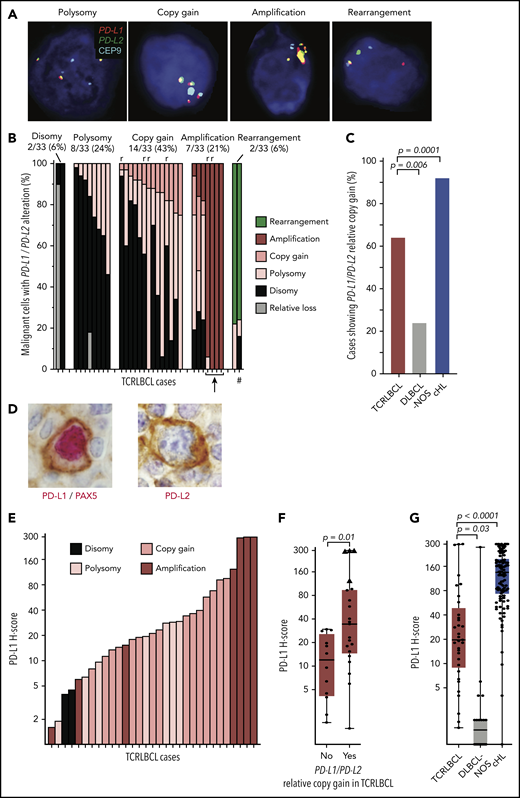 Alterations of PD-L1/PD-L2 correlate with expression of PD-L1 in malignant B cells. (A) Representative FISH images of probes targeting PD-L1 and PD-L2, which lie adjacent on chromosome 9p24.1, and a centromeric region of chromosome 9 (CEP9, aqua) hybridized against individual malignant cell nuclei highlighted by 4′,6-diamidino-2-phenylindole, showing PD-L1/PD-L2 polysomy, copy gain, amplification, and rearrangement (original magnification, ×100). (B) Waterfall plot showing individual TCRLBCL cases (x-axis) and the proportion of malignant cells with the indicated PD-L1/PD-L2 alteration (y-axis); r, relapsed/refractory cases; arrow, 4 cases with high-level amplifications; #, a case with a productive PD-L2 rearrangement (verified by PD-L2 IHC, panel D). (C) Comparison of the proportion of cases with PD-L1/PD-L2 relative gain (ie, copy gain or amplification) across cases of TCRLBCL (n = 33, red), cHL (n = 108, blue),13 and DLBCL-NOS (n = 21, gray). (D) Representative IHC demonstrating nuclear PAX5 (red) and membranous PD-L1 (brown) coexpression by a malignant B cell in a case of TCRLBCL with PD-L1/PD-L2 amplification (left), and representative IHC demonstrating membranous PD-L2 expression (brown, PAX5-staining was not performed) by a malignant B cell in a case of TCRLBCL, demonstrating rearrangement of PD-L2 (right) (original magification, ×100). (E) Waterfall plot showing individual TRLBCL cases (x-axis) and malignant cell-specific PD-L1 H-score (y-axis). The corresponding genetic classification for each case is indicated. (F) Comparison of PD-L1 H-scores for individual cases (● and ▲) displayed according to those with PD-L1/PD-L2 relative gain (ie, amplification or copy gain; n = 21) vs those without (n = 12). Four cases where >75% of tumor nuclei showed PD-L1/PD-L2 amplification are designated with triangles. (G) Comparison of malignant tumor cell PD-L1 H-scores for cases of TCRLBCL (n = 33, red), cHL (n = 106, blue),13 and DLBCL-NOS (n = 20, gray). For box-and-whisker plots (F, G) the median (line), 25th and 75th percentiles (boxes), and extreme values (whiskers) are indicated. Statistical comparisons by the 2-sided Mann-Whitney U test (F, G) and Fisher’s exact test with Bonferroni correction for multiple comparisons (C).