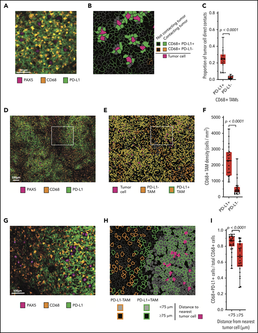 Malignant B cells are in frequent contact with PD-L1+ TAMs. (A) Representative high-power mIF image demonstrating PD-L1 expression on the surface of CD68+ TAMs in contact with a PAX5+ malignant B cells. (B) Cell-cell contact map of the mIF image shown in panel A (same scale). PD-L1+ TAMs, PD-L1− TAMs (not present in the image), and other cells in contact with malignant cells and PD-L1+ TAMs and PD-L1− TAMs not in contact with malignant cells are indicated. (C) Proportion of malignant B-cell contacts for individual cases (●) displayed according to the proportion of contacts with PD-L1+ TAMs vs PD-L1− TAMs (n = 26). (D) Low-power, maximum field-of-view mIF image of TCRLBCL shown in panel A. (E) Cell phenotype map corresponding to the mIF image in panel D: PD-L1+ TAMs, PD-L1− TAMs, and malignant cells are indicated. (F) TAM density for individual cases (●) displayed according to the density of PD-L1+ TAMs and PD-L1− TAMs. (G) Intermediate-power mIF image of the region highlighted in panel D: PD-L1 expression on CD68+ TAMs and PAX5+ B cells. (H) Cell proximity map of the region highlighted in panel E, showing the spatial distribution of PD-L1+ TAMs and PD-L1− TAMs relative to malignant B cells (<75 μm and ≥75 μm). (I) The ratio of PD-L1+ TAMs to total TAMs for individual cases (●) displayed according to whether the TAMs are located <75 or ≥75 μm from malignant B cells. For the box-and-whisker plots (C, F, I) the median (line), 25th and 75th percentiles (boxes), and extreme values (whiskers) are indicated. Statistical comparisons by 2-sided Mann-Whitney U test, Wilcoxon matched-pairs signed rank test, and the Kruskal-Wallis test with Dunn’s test for multiple comparisons.