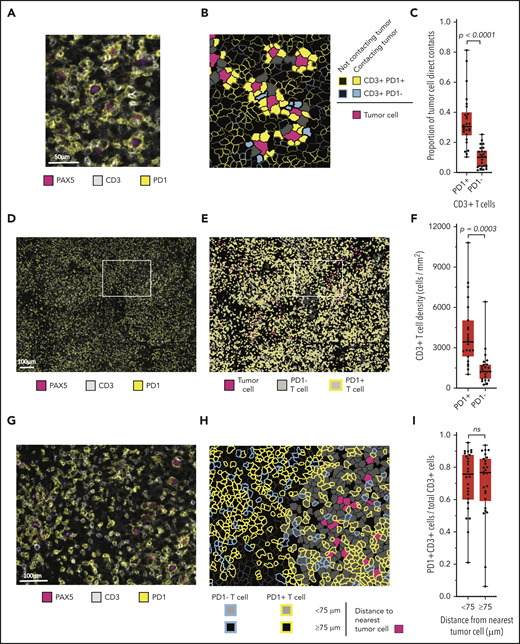 Malignant B cells are in frequent contact with PD-1+ T cells. (A) Representative high-power mIF image demonstrating PD-1 expression on the surface of CD3+ T cells in contact with a PAX5+ B cells). (B) Cell-cell contact map of the mIF image shown in panel A (same scale). PD-1+ T cells, PD-1− T cells, and other cells (solid gray) in contact with malignant cells and PD-1+ T cells and PD-1− T cells (outlined) not in contact with malignant cells. (C) Proportion of malignant cell contacts for individual cases (●) displayed according to the proportion of PD-1+ T-cell contacts vs PD-1− T-cell contacts (n = 26). (D) Low-power, maximum field-of-view mIF image of TCRLBCL in panel A: PD-1 on CD3+ T cells intermixed with PAX5+ B cells. (E) Cell phenotype map corresponding to the mIF image in panel D: PD-1+ T cells, PD-1− T cells, and malignant B cells. (F) T-cell density for individual cases (●) displayed according to the density of PD-1+ T cells and PD-1− T cells. (G) Intermediate-power mIF image of the boxed region in panel D: PD-1 expression on CD3+ T cells intermixed with PAX5+ B cells. (H) Cell proximity map of the region highlighted in panel E: spatial distribution of PD-1+ T cells and PD-1− T cells relative to malignant cells, showing T cells that are located <75 μm from malignant cells and those that are located ≥75 μm from malignant cells. (I) The ratio of PD-1+ T cells to total T cells for individual cases (●) displayed according whether the T cells are located <75 or ≥75 μm from malignant B cells. For the box-and-whisker plots (C,F,I), the median (line), 25th and 75th percentiles (boxes), and extreme values (whiskers) are indicated. Statistical comparisons by the 2-sided Mann-Whitney U test, Wilcoxon matched-pairs signed-rank test, and the Kruskal-Wallis test with Dunn’s test for multiple comparisons.