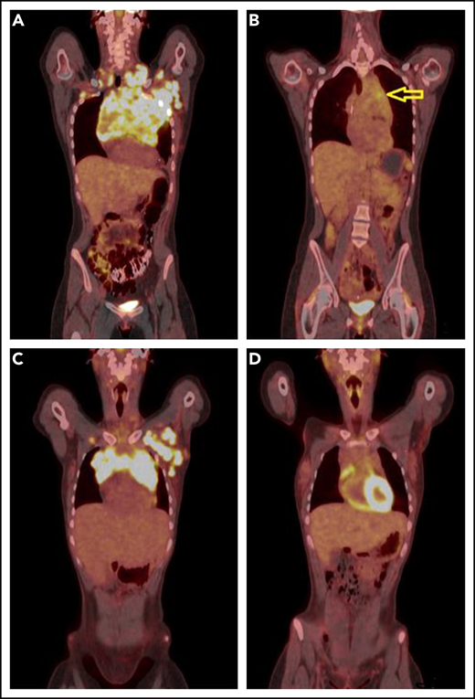 PET-CT’s before and after single agent pembrolizumab. (A) A coronal fused PET-CT image of a 23-year-old woman with cHL shows intensely hypermetabolic bulky lymphadenopathy involving the entire anterior mediastinum, left axillary, bilateral supraclavicular, and subpectoral nodal stations before therapy with pembrolizumab. (B) After 3 cycles of pembrolizumab monotherapy, there was marked anatomic and metabolic improvement of the disease. The residual mass has fluorodeoxyglucose (FDG) activity similar to liver background uptake, with the exception of mild FDG hypermetabolism in the anterior mediastinum (arrow), Deauville 4. (C) A coronal fused PET-CT image of another 23-year-old woman with cHL shows intensely hypermetabolic bulky lymphadenopathy involving the anterior mediastinum and the left axillary and left subpectoral nodal stations with a small right subpectoral lymph node before therapy. (D) After 3 cycles of pembrolizumab monotherapy with CMR, Deauville 3.