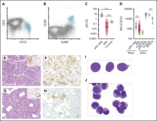 Increased pDCs in a subset of AML. (A-B) Flow cytometric identification of pDCs (aqua population represents pDCs). (C) pDC proportion (percentage of white blood cells) in BM aspirates from patients with AML and normal controls (median ± IQR). AML, AML without pDC expansion; Controls, normal subjects; pDC-AML, AML with pDC expansion. (D) CD123 levels on CD34+ blasts and pDCs (median ± IQR). (E) Hematoxylin and eosin stain of BM biopsy from a representative patient with pDC-AML (inset: anti-CD34 immunostain). (F) Anti-CD123 immunostain of the patient from panel E. (G) Hematoxylin and eosin stain of BM biopsy from another representative patient with pDC-AML (inset: anti-CD34 immunostain). (H) Anti-CD123 immunostain of the patient in panel G. (I-J) Wright-Giemsa stain of flow-sorted leukemic blasts (I) and pDCs (J) from pDC-AML. **P < .01, ***P < .001. Original magnification, ×200 (E-H) and ×1000 (I-J). MFI, mean fluorescence intensity.
