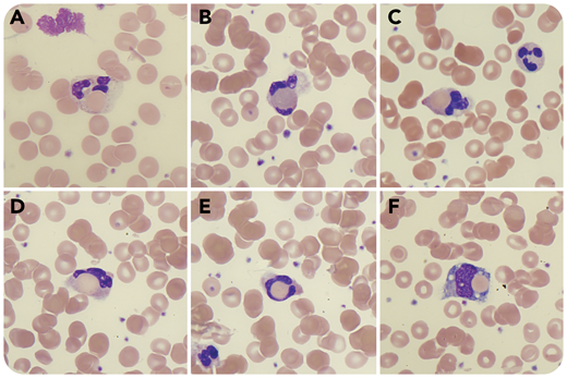 A 27-year-old man presented with fatigue, jaundice, and dark urine 10 days after an episode of high fever, cough, and diarrhea. Laboratory studies revealed hemolytic anemia with hemoglobin 5.9 g/dL, bilirubin 7.3 mg/dL (direct, 0.6 mg/dL), lactate dehydrogenase 1105 U/L (normal, 125-220 U/L), and low haptoglobin (<8 mg/dL). Direct Coombs test was positive for immunoglobulin M (IgM) and C3d, and a cold agglutinin test was negative. Blood smear revealed erythrophagocytosis by neutrophils (panels A-E; modified Wright's stain, original magnification ×100) and occasionally by monocytes (panel F; modified Wright's stain, original magnification ×100). A positive Donath-Landsteiner (DL) test confirmed the diagnosis of paroxysmal cold hemoglobinuria (PCH). Serology for mycoplasma pneumonia was highly positive (IgM, 1:1280). A diagnosis of IgM-mediated PCH due to mycoplasma pneumonia infection was made and the patient was treated with antibiotics and blood transfusions and was instructed to avoid cold.