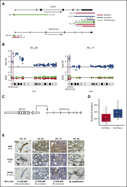 PD-L1 and PD-L2 genetic alterations and aberrant expression of PD-L1 protein in IVLBCL. (A) Distributions and types of SVs involving PD-L1 (CD274) and PD-L2 (PDCD1LG2) are depicted. (B) CNAs of PD-L1 and PD-L2 in 2 patients with IVLBCL, IVL_02 and IVL_11. (C) Novel translocation involving PDCD1LG2 identified in IVLBCL (IVL_05). (D) Number of somatic mutations in patients with and without SVs/CNAs in PD-L1/PD-L2. Box-and-whisker plots show the boxes indicating median and interquartile range, and the whiskers denoting the range. The overlaid points are the observed mutation burden of individual samples. (E) PD-L1 protein expression with IHC analyses using 3 different anti–PD-L1 antibodies: 28-8, E1J2J, and SP142. Skin biopsy samples (IVL_14), BM clot section samples (IVL_07, 12, and 18), and lung biopsy samples (IVL_02) were used for IHC analysis. Hematoxylin and eosin stain; original magnification ×400. AsCN, allele-specific copy number; CN, copy number; DRT, disruption; EC, extracellular domain.