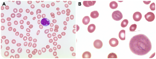 An 8-year-old girl presented with a 4-week history of bruising in her legs and arms. She had weight loss without fevers or night sweats. On initial workup, her bloodwork showed leukocytes 25 × 109/L, hemoglobin 80 g/L, and platelets 11 × 109/L. Her blood film revealed myeloblasts 16.8 × 109/L with several containing Auer rods (panel A; original magnification ×500; Wright-Giemsa stain) and red blood cells with basophilic stippling and a Cabot ring (panel B; original magnification ×1000; Wright-Giemsa stain). Subsequent bone marrow aspirate and biopsy confirmed an underlying diagnosis of acute myelomonocytic leukemia, but other cell lines did not demonstrate any dysplastic changes. Cytogenetics did not reveal any abnormalities (normal female karyotype). Molecular studies showed biallelic CEBPA mutation. The patient achieved complete remission after induction chemotherapy, and no remaining blasts or Cabot ring were appreciated on subsequent peripheral blood films.