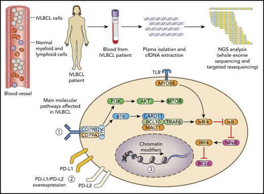 IVLBCL selectively localizes to the lumen of blood vessels where the lymphoma grows and disseminates. Using a liquid biopsy strategy that exploits whole-exome sequencing has elucidated the disease genomic landscape. The affected molecular pathways include (1) BCR/NF-κB, (2) immune checkpoint regulators (PD-L1 and PD-L2), and (3) chromatin remodeling. Molecular lesions of PD-L1 and PD-L2 induce overexpression of the corresponding protein, which highlights immune escape as a major pathogenetic feature of IVLBCL that can be targeted with immune checkpoint inhibitors.