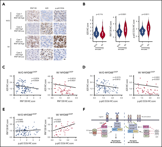 Expression of A20 and RNF138 in relationship to NF-κB activation in human lymphomas. (A) Representative images of IHC staining for RNF138, A20, and p-p65 Ser536 in lymphomas with and without MYD88L265P. The images were taken from the same area for each target in individual lymphomas. Targets were stained with DAB as the chromogen (brown). The bar represents 10 μm. (B) Comparison of A20, RNF138, and p-p65 Ser536 expression between lymphomas with and without MYD88L265P. (C) Correlation between the expression of A20 and RNF138 in lymphomas with and without MYD88L265P. (D) Correlation between the expression of A20 and p-p65 Ser536 in lymphomas with and without MYD88L265P. (E) Correlation between the expression of RNF138 and p-p65 Ser536 in lymphomas with and without MYD88L265P. Pearson’s correlation coefficient tests provided the data in panels C-E. (F) The working model of MYD88, RNF138, and A20 in regulating physiological and oncogenic NF-κB activation. W, with; W/O, without.