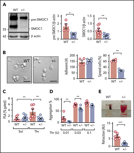 SMOC1 deficiency decreases platelet function in murine platelets. (A) Expression of the premature (pre-SMOC1) and mature secreted (SMOC1) forms of SMOC1 in platelets from WT and SMOC1+/− (+/−) littermates; n = 6 animals per group. *P < .05, **P < .01, Student t test. (B) Adherent and nonspread (inactive) platelets isolated from WT and SMOC1+/− (+/−) mice after seeding onto collagen; n = 4 animals per group. Scale bars, 10 μm. **P < .01, Student t test. (C) Platelet-leukocyte aggregates (PLA) in isolated whole blood from WT and SMOC1+/− (+/−) mice following treatment with solvent (Sol) or thrombin (Thr); n = 6 animals per group. **P < .01, 2-way ANOVA and Newman-Keuls test. (D) Thrombin (Thr)-induced platelet aggregation in washed platelets from WT and SMOC1+/− (+/−) mice; n = animals 7 per group. **P < .01, 2-way ANOVA and Bonferroni test. (E) Thrombin-induced clot retraction using erythrocyte-spiked platelet-rich plasma from WT and SMOC1+/− (+/−) mice; n = 6 animals per group. ***P < .001, Student t test.