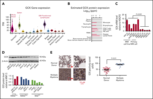 GCK expression is elevated in MM. (A) The GCK gene and transcript expression values were obtained from the publically available genotype-tissue expression portal on 30 June 2019 and shown as reads per kilobase transcript per million reads (RPKM). (B) The GCK protein expression values were obtained from the Human Integrated Protein Expression Database (HIPED) on 30 June 2019. Parts per million (PPM): each protein entity is enumerated relative to all other protein molecules in the sample. (C) mRNA from a panel of MM cell lines (MM.1S, H929, RPMI-8226, U266), primary MM cell (MM 1 and MM 2), PBMC#1 and PBMC #2, BMSC #1 and BMSC#2, and HEK-293 cells was extracted and GCK mRNA expression was analyzed by quantitative PCR with β-actin as control. GCK mRNA level was calculated relative to its level in HEK-293. (D) RASMut MM cell lines (MM.1S, RPMI-8226, JJN3, H929, JIM3, and MOLP-8) and RASWT cell lines (U266, OPM2, LP-1, KMS12-PE, and SKMM2) were analyzed for GCK protein levels by western blotting of whole cell extracts using β-actin as a loading control. GCK protein levels were quantified using ImageJ software. (E) Immunohistochemistry of paraffin-embedded bone marrow biopsy sections for GCK expression (Brown staining) of normal donor (n = 26) and myeloma patients (n = 26). The slides were scanned using a high-resolution scanner (Leica SCN400 Slide Scanner) at ×40 magnification. Images were analyzed using Aperio ImageScope software (Aperio Technologies, Inc., Vista, CA). Statistical analysis was performed using the Aperio Positive Pixel Count algorithm in the ImageScope viewing software.