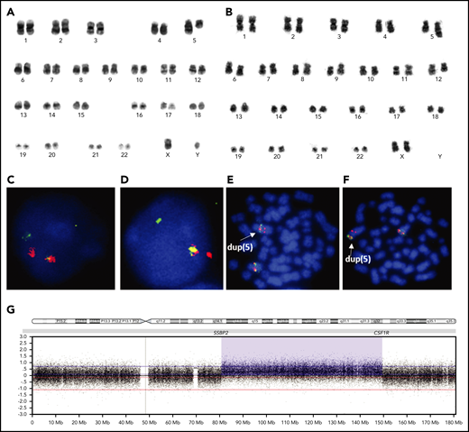 Karyograms, FISH, and SNP 6.0 profile of SSBP2-CSF1R+patients. (A) Karyogram from the diagnostic bone marrow of patient 3 showing that both copies of chromosome 5 are abnormal, consistent with the balanced translocation, t(5;5)(q14;q33). (B) Karyogram from the relapsed bone marrow of patient 9 showing that 1 copy of chromosome 5 is abnormal, consistent with dup(5)(q14q33). (C-D) FISH using SSBP2 and CSF1R BA probes, respectively, confirming the balanced rearrangement in patient 1. (E-F) FISH using SSBP2 and CSF1R BA probes, respectively, showing a partial duplication of both probes on the duplicated 5q in patient 9. (C-F) Original magnification ×100; DAPI, Spectrum Orange and Spectrum Green stain. (G) SNP array profile of chromosome 5 in patient 9, showing duplication of the long arm of chromosome 5, with breakpoints in SSBP2 at 5q14 and CSF1R at 5q33. This duplication was conserved between diagnosis and relapse.