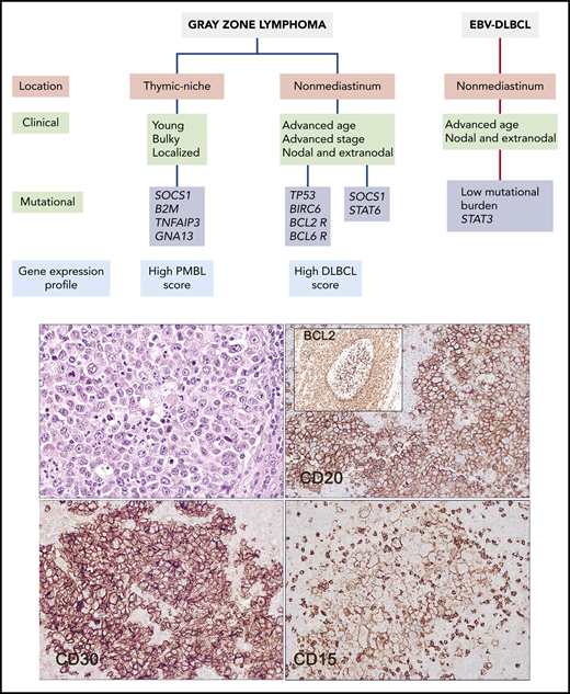 Clinical, biological, and pathological features of GZL and related entities. GZL should be distinguished from EBV-positive DLBCL, which may show similar morphological features. The current study provides new data that more clearly separate GZL arising in the thymic niche from those arising in extramediastinal sites. The clinical case illustrated arose in an inguinal lymph node in a 54-year-old woman. It has features of GZL, being positive for CD20, CD30, and CD15 (hematoxylin & eosin and immunohistochemical staining for the indicated markers). The tumor was positive for BCL2 rearrangement. Notably, a focus of in situ follicular neoplasia was identified in “reactive follicles” adjacent to the tumor mass (inset). The patient relapsed 2 years later with follicular lymphoma, shown to be clonally related to the nonmediastinal GZL.
