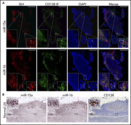 miR-15a/16 expression in normal human lymphoid tissues and MM cells. (A) miR-15a or miR-16 colocalization with PC marker CD138 in human LNs. CD138 expression was assessed by IF (green), followed by ISH analysis for miR abundance (red) on the same frozen slide. 4′,6-Diamidino-2-phenylindole (DAPI; blue) was used for nuclear counterstaining. One representative example is shown. Note colocalization of miR-15a, miR-16 signal, and CD138 in PC-rich regions as well as in individual PCs (insets, arrowheads). Scale bar, 800 µm. (B) miR-15a or miR-16 (ISH, purple) and CD138 (IHC, brown; counterstain, blue) expression in consecutive FFPE LN sections from a healthy individual. Note higher miR-15a and miR-16 abundance in a PC cluster (inset) and germinal center (GC) compared with other lymphoid cells. Scale bar, 200 µm.
