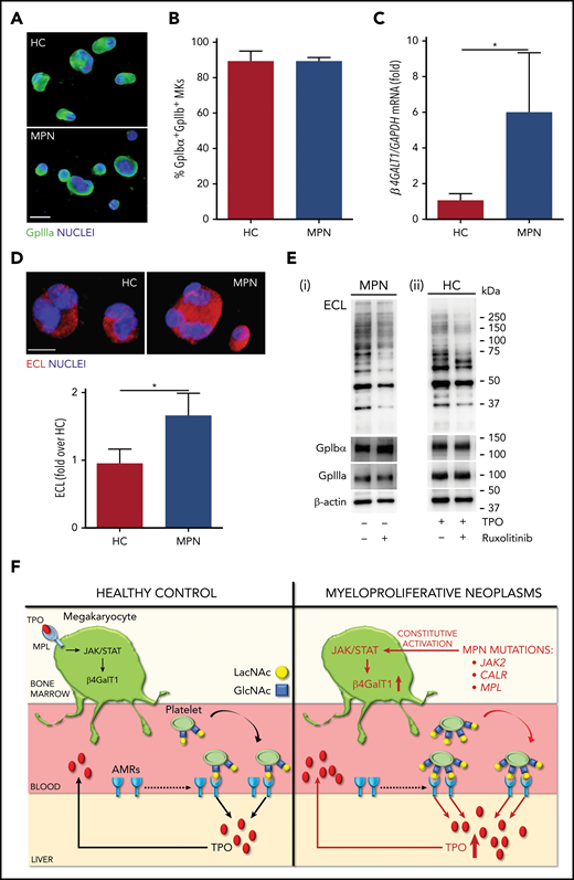 Megakaryocytes from MPNs express increased B4GALT1 under the control of JAK/STAT pathway. Megakaryocytes were differentiated from human peripheral blood progenitors from HCs and MPN patients. (A) Representative immunofluorescence staining of GpIIIa (green, GpIIIa; blue, nuclei; scale bar, 25 µm). (B) Percentage of GpIIb+GpIbα+ megakaryocytes (MKs) at the end of the culture. Data are presented as mean ± SD (n = 8; P, not significant). (C) B4GALT1 expression differentiated from HCs and patients. Data are presented as mean ± SD (n = 3; *P < .05). (D) Immunofluorescence of megakaryocytes differentiated from HC and patients with MPN using ECL (red, ECL; blue, nuclei; scale bar, 20 μm). The quantification of ECL fluorescence in megakaryocytes is reported. Data are presented as mean ± SD (n = 8; *P < .001). (E) MPN megakaryocytes were cytokine starved and treated or not with ruxolitinib (i). HC megakaryocytes were cultured with a high dose of TPO and treated or not with ruxolitinib (ii). Two MPNs (JAK2 and MPL) and 3 HCs were tested with comparable results. Here, we present the representative western blot analysis of total lysates from the JAK2-mutated patient and 1 HC, probed with ECL in order to evaluate the galactosylation status. GpIbα, GpIIIa, and β-actin were used as loading controls. (F) Diagram of how B4GALT1 regulates megakaryocyte and platelet galactosylation in physiology and disease. In HCs (left panel), B4GALT1 is expressed under control of TPO. Megakaryocytes produce and release platelets into the bloodstream that expose galactose becoming ligands for the AMRs to promote TPO production by the liver. In MPNs (right panel), constitutive activation of JAK/STAT signaling determines an increased expression of B4GALT1 resulting in the production of platelets that are highly galactosylated. This can stimulate hepatocytes to release high amounts of TPO into bloodstream.