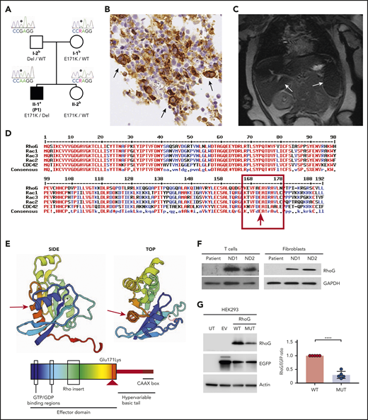 Identification of a genetic variant causing loss of RHOG expression. (A) Pedigree of the HLH patient family. Solid symbol (▪) indicates affected patient (P1); open symbol (○) corresponds to unaffected family members. The RHOG c.511G>A, p.Glu171Lys variant (RHOG gene reference sequences Ensembl: ENSG00000177105, ENST00000533217, GRCh37.p13) is indicated by E171K, the RHOG ∼33kb deletion is indicated as Del, the WT alleles by WT. aIndividual evaluated by whole-exome sequencing, Sanger sequencing, single nucleotide polymorphism (SNP) genotyping, and qPCR analysis. bIndividuals evaluated by targeted screening of the RHOG c.511G>A, p.Glu171Lys variant by Sanger sequencing, SNP genotyping, and qPCR analysis. (B) Immunohistochemistry of the patient bone marrow biopsy showing staining for CD68. Arrows indicate histiocytic cells with hemophagocytosis. (C) Abdominal magnetic resonance image revealing hepatosplenomegaly and abnormal signal intensity in both spleen and liver. (D) Amino acid alignment of the selected ρ family GTPase members demonstrating high conservation of the mutated residue. (E) A 3-dimensional model (top) and a scheme (bottom) of RhoG domain organization and localization of the missense mutation (red arrow). (F) Immunoblot analysis of the lysates from the patient and normal donor (ND) expanded T cells and fibroblasts. (G) Immunoblot analysis of the lysates from HEK293 cells untransfected (UT) and transfected with empty vector (EV) or vectors encoding WT and Glu171Lys mutant (MUT) RHOG genes. The difference in WT and mutated RhoG expression levels were quantified by normalization to EGFP expression (graph on right). Data are presented as the mean ± standard error of the mean (SEM). P values were calculated using a multiple Student t test. *****P < .0001.