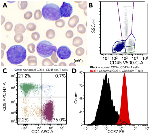 A 59-year-old man with cirrhosis admitted for methicillin-susceptible Staphylococcus aureus bacteremia was found to have hyperleukocytosis (white blood cell count 225 109/L). Peripheral blood showed polymorphic lymphocytes: large with irregular nuclear contours, medium with prominent nucleoli, and small with cytoplasmic projections (panel A; Wright-Giemsa, original magnification ×60). Flow cytometry showed an abnormal CD45 dim/negative population (panel B), which was a polytypic mixture of 4 mature CD3+ T-cell populations with a normal CD4:CD8 ratio (∼3:1) (panel C). The predominant population (76% of abnormal T cells) showed low side scatter, expressed CD4 and all pan-T antigens, and was negative for immature markers (CD34/TdT/CD1a). Separate abnormal CD8+, CD4/CD8 double-negative, and CD4/CD8 double-positive T-cell populations comprising 20%, 2%, and 0.7% of abnormal T cells, respectively, expressed a similar immunophenotype but showed variation in forward and side scatter. Human T-cell lymphotropic virus type 1/2 serology was negative. ATM T2947N and JAK3 A573V mutations were identified at variant allele frequencies (VAFs) of 94% and 38%, respectively, and fluorescence in situ hybridization showed TCL1A gene rearrangement in 78% of nuclei.