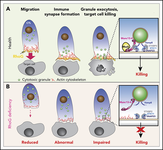 Functions of RhoG in health and effects of RhoG deficiency.(A) Schematic depicting the normal stages of CD8+ T cell recognition and killing of target cells (Health). Upon activation, cytotoxic T lymphocytes (CTL) polarize and migrate toward the target cell via polymerization of actin (shown in red) at the leading edge of the cell, where RhoG (yellow) concentrates. CTLs then make contact with target cells, where they form a stable IS that is driven by the accumulation of actin and RhoG. Meanwhile, CGs (green) are transported to the IS. Granules dock at the IS in an area where actin has cleared through the direct interaction of RhoG with Munc13-4. Inset, The interaction of RhoG with Munc13-4 brings the CGs in contact with the plasma membrane (PM) of the CTL. Subsequent interaction of SNAP receptor (SNARE) proteins present in the CGs (Vamp8) and with those on the PM (Syntaxin 11, SNAP23), along with the SNARE-binding protein STXBP2, enables fusion of the CGs with the PM, releasing granule contents onto the target cell. (B) CTLs lacking expression of RhoG (RhoG deficiency) display reduced polarization and migration, abnormal IS morphology, reduced actin polymerization and clearance zones, and diminished CG exocytosis and target cell killing due to the inability of the granules to properly dock at the IS (inset).
