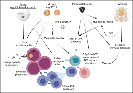 Pathogenesis of PRCA. Various mechanisms may lead to PRCA. (1) Viral infections (eg, B19 parvovirus) and a variety of drugs may have a direct cytotoxic effect against erythroid precursors or also exert an indirect pathogenic effect via a molecular mimicry mechanism. The resulting cross-reactive TCR recognition may lead to a breach of tolerance with polyclonal CTL responses. (2) This latter phenomenon may also be triggered by alteration of immune tolerance because of the presence of thymoma (or thymic dysfunction) with subsequent LGL clonal expansion (in some cases carrying STAT3 mutations). (3) Lack of viral clearance from immunodeficiency (eg, hypoglobulinemia) may be the cause of elicitation of aberrant CTLs responses. Alternatively, in the context of immunodeficiency antibody responses or the inability of TCR recognition may lead to generation of autoreactive T cells with alterations of TCR repertoires evading immune-tolerance mechanisms. For instance, the presence of T-cell subsets with predominant expression of γδ+ TCR rearrangements lacking HLA class I restriction could explain the attack of erythroid progenitors, which physiologically present downregulation of HLA class I antigens. GS, Good syndrome; STAT3, signal transducer and activator of transcription 3.