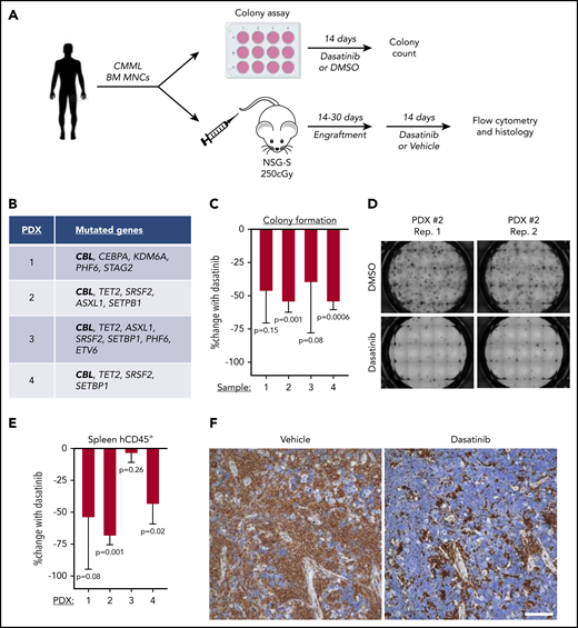 Dasatinib inhibits proliferation of CBL-mutated CMML patient samples in vitro and in vivo. (A) Schematic of the experimental workflow of CMML xenotransplantation model system. (B) Genes mutated in 4 CMML patient samples used for in vitro and in vivo experiments. (C) Percentage change in colony formation with 250 nM dasatinib compared with DMSO after 2 weeks of treatment (mean and SD of 3-4 replicate wells are depicted). (D) Representative images of colony formation by CMML patient sample 2 after 2 weeks in the presence of DMSO or 250 nM dasatinib. (E) Percentage change in human CD45+ cells in the spleens of NSG-S mice engrafted with CMML patient samples and treated with vehicle or 50 mg/kg dasatinib via oral gavage over 2 weeks (mean and SD of 3-5 mice per group are depicted). (F) Anti-hCD45 immunohistochemistry in spleen tissue sections from mice engrafted with CMML patient sample 2 and treated with vehicle or dasatinib for 10 days. Anti-human CD45 stain; scale bar, 70 μM; original magnification ×100. P values were determined by 2-tailed Student t test comparing the mean for vehicle treatment to each dasatinib-treated well or mouse. BM MNC, bone marrow mononuclear cell.