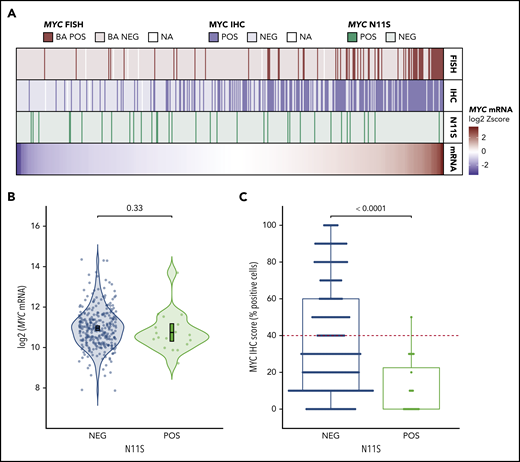 MYC-N11S polymorphism is associated with decreased MYC protein expression as detected by IHC using the Y69 antibody. (A) MYC mRNA expression is shown in the bottom track as a heatmap for the 446 tumors in which MYC sequencing data were available. Tumors are linearly arranged from lowest to highest expression, and the corresponding N11S status, MYC IHC status, and MYC rearrangement status for each tumor are shown in the tracks above the heatmap. Break-apart positive (BA POS) refers to tumors positive for MYC rearrangement (MYCTr). (B) Expression of MYC mRNA in N11S-positive (POS) and N11S-negative (NEG) tumors. P value was determined by an unpaired 2-sided Student t test. Error bars represent the mean and 95% confidence intervals. (C) Percentage of tumor cells positive for MYC IHC staining in N11S POS and NEG tumors. The red dotted line indicates the ≥40% threshold used to identify MYC IHC positivity. The P value was determined by using the Mann-Whitney U test. Only tumors with IHC scores on a 10% increment scale of percent positively stained cells are included in B and C (n = 323).