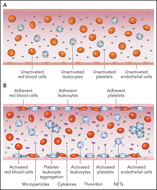 The prothrombotic and proadhesive blood milieu in the MPNs. (A) Under normal conditions, the monolayer of quiescent ECs that line the intimal surface of the circulatory tree displays a thromboresistant, anticoagulant, antiadhesive, anti-inflammatory phenotype that promotes blood fluidity. (B) Activation or dysfunction of ECs in the MPNs changes this milieu to cause activation and adhesion of platelets, leukocytes, and red cells to endothelium, formation of circulating platelet-leukocyte aggregates, NETs and microparticles, generation of thrombin, and release of proinflammatory cytokines. The main triggers for this “thromboinflammatory” state are most likely (i) cell-intrinsic abnormalities of platelets, leukocytes, red cells, and ECs as a function of their origin in a mutant hematopoietic clone and (ii) the establishment of a proinflammatory state, both serving as mutually amplifying factors. Professional illustration by Patrick Lane, ScEYEnce Studios.
