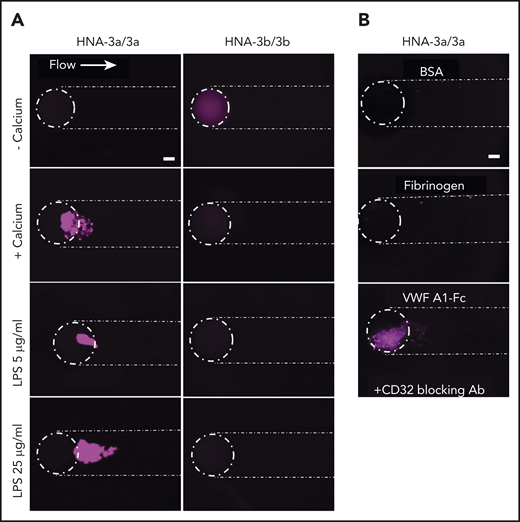 Neutrophil activation on VWF at 100 s−1 is HNA-3a, calcium, and VWF A1-domain dependent and can be exacerbated by LPS challenge. (A) Representative images of HNA-3a or HNA-3b neutrophils (anti-Ly6G IgG) submitted to a 100 s−1 shear rate in the absence or presence of calcium or preactivated with LPS prior to perfusion (5 or 25 µg/mL) (Cellix flow chambers, n = 3 donors per genotype). (B) Representative images of HNA-3a neutrophils perfused at a 100 s−1 shear rate on immobilized BSA, fibrinogen, or VWF A1-Fc domain. Neutrophil Fc receptors were blocked with anti-CD32 antibody (Ab) for A1 domain experiments. Scale bars, 100 µm. Lines delimit flow channels and the well entrance (n = 3 donors per genotype).