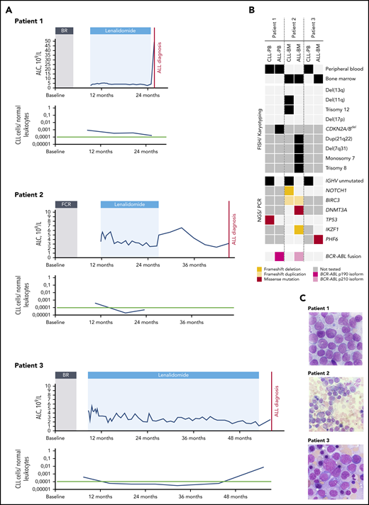 Treatment and disease characteristics. (A) Absolute lymphocyte counts (ALCs) and MRD of the patients during lenalidomide maintenance therapy. Red lines show the time point of ALL diagnosis, and green lines show the threshold for undetectable MRD (10−4 leukemic cells). Patient 1: CLL MRD levels in peripheral blood (PB) decreased steadily from 8.6 × 104 to 1.6 × 104 after 16 months of lenalidomide treatment. BCR-ABL1–positive common B-ALL was diagnosed but no bone marrow (BM) infiltration of CLL cells could be detected morphologically (panel C). Patient 2 received lenalidomide for 15 months before discontinuing because of increased creatinine levels. Undetectable MRD in PB (<10−4) was achieved after 6 months and maintained at month 12 of lenalidomide therapy. When BCR-ABL1–positive common ALL was diagnosed, there were no signs of CLL cells in the PB or BM by cytomorphology or immunophenotyping. Patient 3 received lenalidomide for 45 months before treatment was stopped after a data safety monitoring board recommendation. Although his MRD level in PB had dropped sustainably below 10−4 after receiving lenalidomide for 6 months, a reciprocal increase of residual CLL cells to 8 × 10−3 was observed 2 months after lenalidomide was discontinued. Three months after the end of maintenance treatment, Philadelphia chromosome–negative common ALL was diagnosed after a BM biopsy prompted by persisting pancytopenia. (B) Summary of selected genetic alterations at CLL and ALL time points, including fluorescence in situ hybridization (FISH) analysis for recurrent aberrations in CLL, IGHV status, cancer-related mutations according to next-generation sequencing (NGS), and BCR/ABL status. We performed BCR-ABL1 reverse transcriptase quantitative polymerase chain reaction (PCR) in earlier PB samples from patients 1 and 2. No BCR-ABL1 fusion transcripts were detected in a blood sample 12 months after initiation of maintenance in patient 2 and 11 months after start of lenalidomide treatment in patient 1. (C) Giemsa stains of BM samples from all 3 patients at the time of ALL diagnosis (magnification ×100). BR, bendamustine, rituximab; FCR, fludarabine, cyclophosphamide, rituximab.