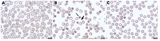 A term male infant with aortic coarctation developed neonatal necrotizing enterocolitis on day of life (DOL) 6 requiring bowel resection and peritoneal washout. On DOL7, he developed jaundice and dark-colored urine with a decreasing hemoglobin level (12.3 to 10.6 g/dL) and an increased reticulocyte count (260 × 109/L; 7.3%). Plasma hemoglobin was >500 mg/dL and lactic acid dehydrogenase was 1124 units/L. Review of a peripheral blood smear from DOL5 showed unremarkable red blood cell (RBC) morphology (panel A: 100× objective, ×50 total magnification). The smear on DOL7 demonstrated abundant dense microspherocytes (thin arrow; panel B: 100× objective, ×50 total magnification). Peritoneal fluid cultures grew Clostridium perfringens. Antibiotic treatment was initiated, and the patient’s intravascular hemolysis stabilized. Repeat smear on DOL9 demonstrated improvement in spherocytosis (panel C: 100× objective, ×50 total magnification).