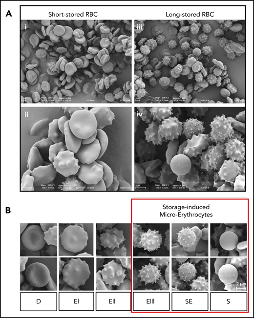 Accumulation of morphologically altered RBCs during storage. (A) Panoramic (×2000) (i) and detailed (×5000) (ii) views of short-stored RBC sample (day 12 of storage) containing a majority of discocytes (D) and type I (EI) or II echinocytes (EII), and panoramic (×2000) (iii) and detailed (×5000) (iv) views of long-stored RBC sample (day 41 of storage) containing abundant EIII, spheroechinocytes (SE), and spherocytes (S). (B) Representative scanning electron images of RBC shapes observed during storage in SAGM: D, EI, EII, EIII, SE, and S; numerically zoomed regions from 2000× acquisitions. Red square highlights morphologically altered RBCs defined as SMEs. Scale bars = 2 μM.