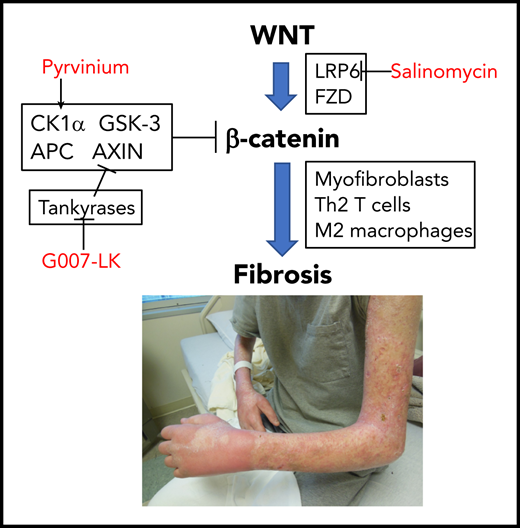 Zhang et al propose that aberrant canonical WNT signaling in cGVHD leads to fibrosis and is blocked by WNT pathway inhibitors.