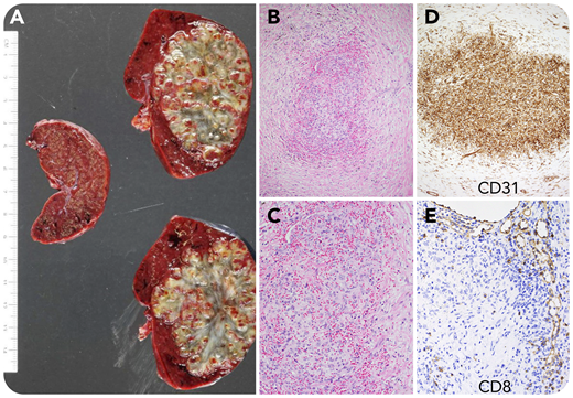 A 25-year-old woman with an incidental 8-cm splenic mass underwent splenectomy. Cut surface of the 280-g spleen demonstrated a sharply defined bosselated mass, in which was found multiple reddish-brown bulging nodules demarcated by dense tan fibrous tissue and central scarring (panel A). The nodules comprised vascular spaces (panels B-C, hematoxylin and eosin stain, original magnification ×100 and ×200, respectively) lined by CD31+ endothelial cells (panel D, original magnification ×100) in a background containing red cells and myofibroblasts that stained for smooth muscle actin and myosin (not shown). CD8 stain reveals that sinusoids present in adjacent red pulp (right) are absent from the nodules (panel E, original magnification ×200).