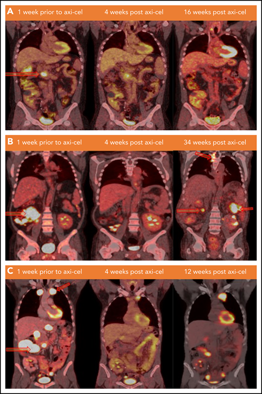 Lymphoma status before and after CAR T-cell infusion. (A) PET/CT scans of patient 1 at the specified time points. Hypermetabolic pancreatic lesion is indicated at week −1 (arrow). (B) PET/CT scans of patient 2 demonstrating from left to right: hypermetabolic cecal mass and ileocolic lymphadenopathy lesions (arrows), no FDG avid lesion (remission), and development of new lesions in thoracic spine, left posterior abdomen, and in the right mid-abdomen (relapse) at weeks −1, +4, and +34 of axi-cel therapy, respectively. (C) PET/CT scan of patient 3 demonstrating from left to right: hypermetabolic left anterior mediastinal mass and multiple abdominal lymph nodes (arrows), interval decreasing in size and metabolic activity of these lesions (partial response), and progression at weeks −1, +4, and +12 of axi-cel therapy, respectively. FDG, fluorodexoglucose.