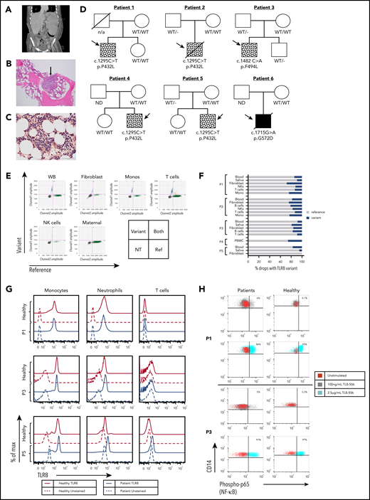 Patients have mosaic and germline variants in TLR8 with normal expression of TLR8 protein and enhanced responsiveness to TLR8 stimulation. (A) Abdominal computed tomography scan from P1 showing marked splenomegaly. (B) H&E staining of bone marrow biopsy specimen (P3) showing hypocellularity for age with lymphohistiocytic aggregate (arrow). (C) Leder staining demonstrating myeloid hypoplasia (P3). (D) Family pedigrees of the 6 patients with variants in TLR8. Symbols with dots indicate mosaicism, and the solid black box indicates a germline variant in P6 (ND, not done). (E) ddPCR of patient DNA showing droplets with TLR8 variant p.P432L (upper left), WT TLR8 (lower right), both templates (upper right), or no TLR8 template (lower left) for P1 and the mother. Monos, monocytes; NK, natural killer; WB, whole blood, NT, no TLR8 template. (F) Percentage of droplets with variant or WT sequence in DNA or cDNA from whole blood or PBMCs, saliva, fibroblast lines, and/or sorted cell populations. (G) Intracellular TLR8 expression by flow cytometry in cells from age-matched healthy controls (solid red lines) and patients (P1, P3, and P5, solid blue lines). Similar expression of TLR8 was observed in patient monocytes and neutrophils. CD3+ T cells did not express TLR8. Red dashed line and blue dashed line indicates unstained control in healthy controls and patients respectively. (H) Expression of phosphorylated p65 (NF-κB) in monocytes (CD14+) from patients (P1 and P3) and healthy age-matched male controls stimulated with indicated doses of TLR8 agonist TL8-506. A small percentage (5% to 6%) of patient monocytes responded to the lower dose (100 ng/mL) of the stimulant. Healthy cells responded at the highest dose of TLR8 stimulation. There was no statistical difference between the patient cells and healthy cells with respect to their response at the highest dose of stimulation.