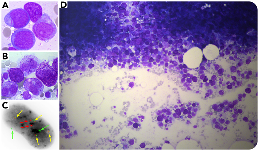 A 66-year-old woman with t(8;21)(q22;q22) therapy-related acute myeloid leukemia (AML) with molecular disease persistence after induction and consolidation chemotherapy (respectively, cytarabine/daunorubicin and cytarabine) underwent bone marrow (BM) examination to investigate a recent onset of pancytopenia. BM smears revealed myeloblasts (91%) and atypical mast cells (MCs) often hypogranulated with a bilobed nucleus (panels A-B: May-Grünwald-Giemsa stain, ×100 objective, original magnification ×1000). After reinduction chemotherapy, BM aspiration revealed a massive infiltrate of atypical MCs (70%) with few blasts (<5%) (panel D: May-Grünwald-Giemsa stain, ×20 objective, original magnification ×200). The patient had skin lesions (not biopsied). Flow cytometry analysis showed CD2/CD25-aberrant expression on MCs. Serum tryptase level exceeded 200 ng/mL and molecular analysis by next-generation sequencing highlighted a KIT D816V mutation (variant allele frequency, 14%) that was absent at AML diagnosis. The diagnosis of systemic mastocytosis (SM) with an associated hematological neoplasm was confirmed. Fluorescent in situ hybridization analysis on BM smears showed 2 t(8;21)(q22;q22) with RUNX1-RUNX1T1 rearrangements in 47% of tetraploid nucleated cells (panel C: fluorescent in situ hybridization analysis, ×100 objective, original magnification ×1000; red arrows, RUNX1 gene; light green arrows, RUNX1T1 gene; yellow arrows, RUNX1-RUNX1T1 fusion signals), indicating its presence in the MC compartment. This result favors a common origin for MCs and myeloblasts.