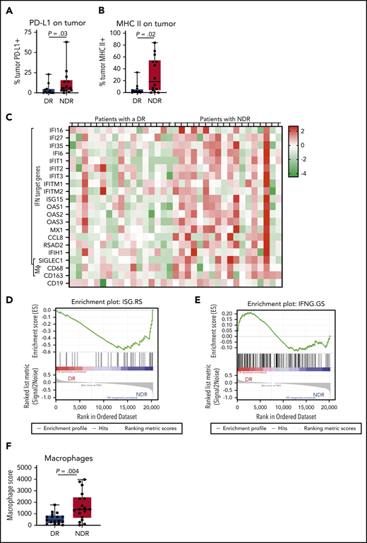 Tumor IFN signaling and macrophage markers associate with a lack of durable response after axi-cel. Baseline tumor biopsy specimens were collected within 1 month before axi-cel infusion. Multiplex immunofluorescence on baseline tumor biopsy specimens (n = 26) using a panel consisting of tumor markers CD19 and CD20, MHC I and II, CD3, and PD-L1 (supplemental Figure 1). (A-B) The percentage of tumor cells (CD19+ and/or CD20+) that are positive for PD-L1 (A) and MHC II (B) are shown, comparing patients with NDR vs those with a DR to axi-cel. (C) Differential gene expression using the NanoString IO360 panel (770 genes) comparing patients with NDR (n = 18) vs those with a DR (n = 17). Shown is a heatmap including rows indicating known IFN target genes on the panel as well as macrophage (Mϕ) markers and CD19. Each column represents an individual patient sample. The heatmap indicates z scores for each gene. RNA-sequencing was performed on baseline biopsy specimens in patients who went on to have a DR (n = 10) or NDR (n = 8). (D-E) Gene set enrichment analysis showing the enrichment of the tumor IFN signature ISG.RS in patients with NDR (D) and the enrichment of the T-cell IFN signature IFNG.GS in patients with DR (E). (F) Macrophage score by NanoString nSolver advanced analysis, compared between patients with NDR and DR. P values according to nonparametric (Mann-Whitney) t tests.